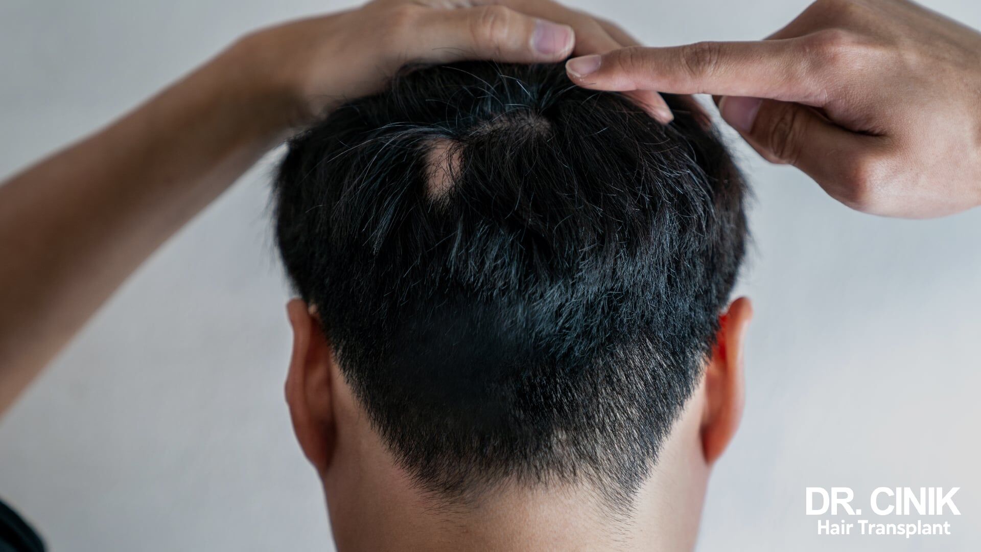 Trichotillomania: Understanding and Treating the Compulsive Hair Pulling Disorder