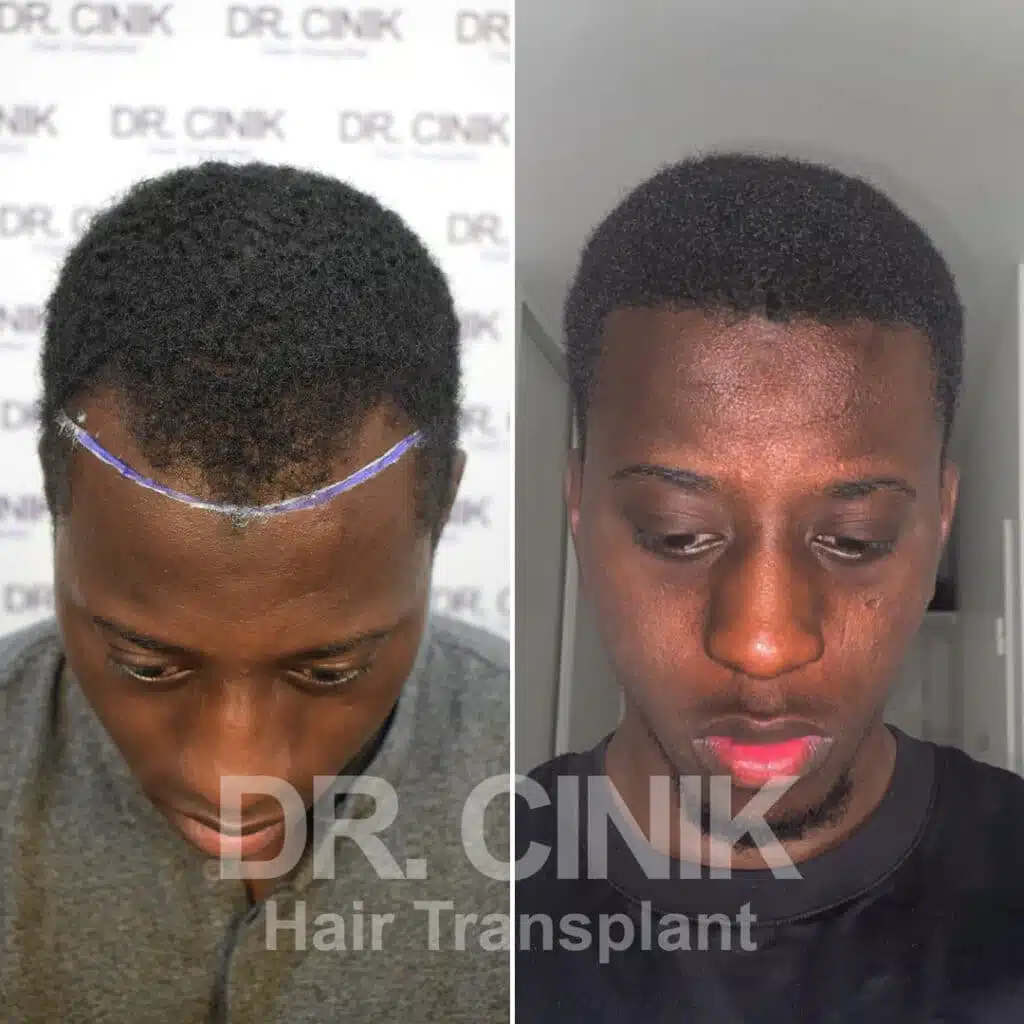 Before and after comparison of an Afro hair transplant with 3050 grafts, showing results 12 months post-procedure. Initial Norwood II pattern showcasing transformation.