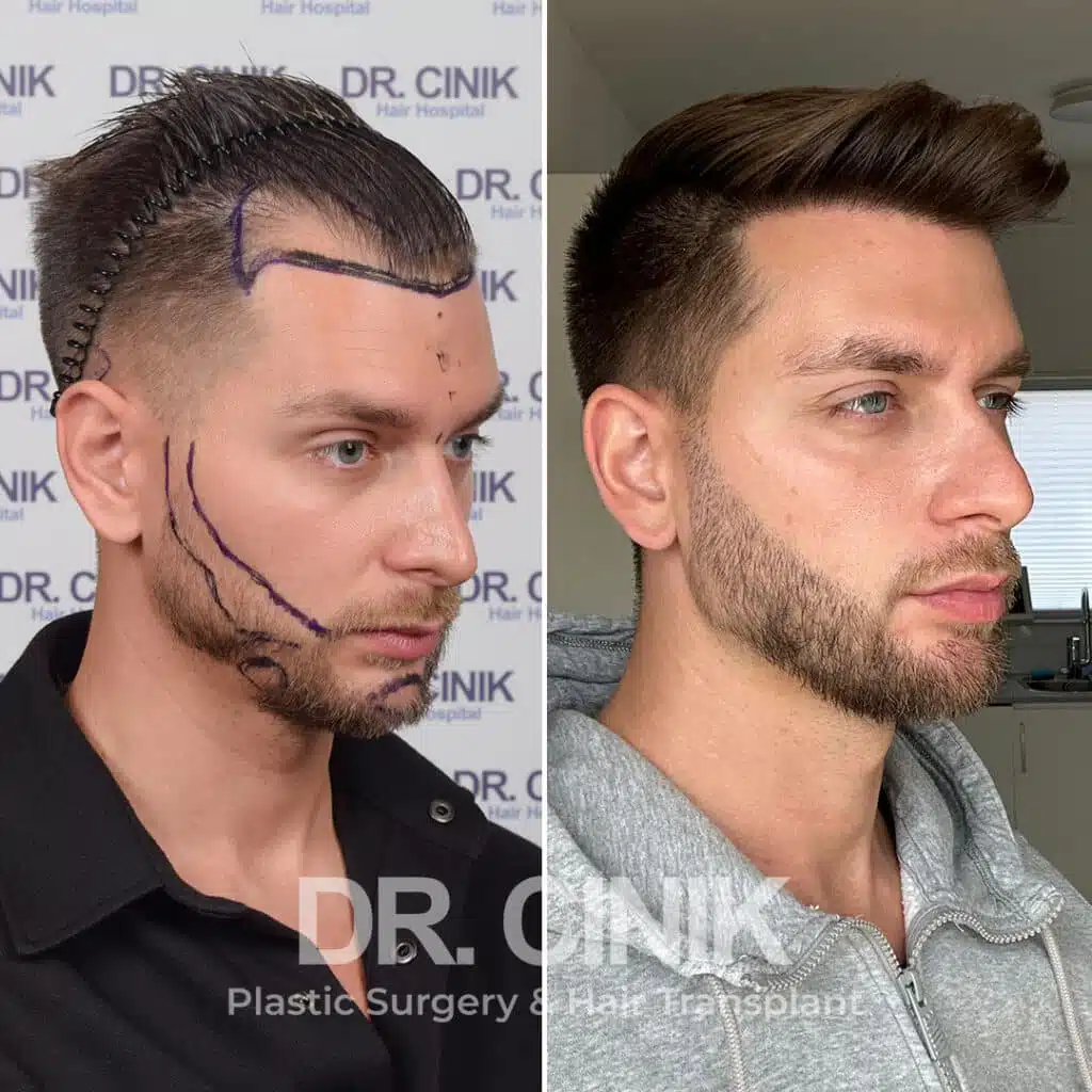 Before and after comparison of a beard hair transplant with 4250 grafts, showing results 12 months post-procedure. Initial Norwood III pattern showcasing transformation.