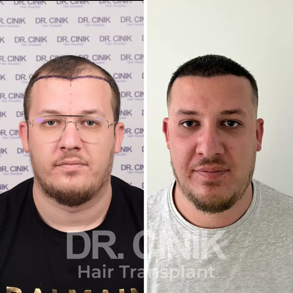 Before and after comparison of a DHI hair transplant with 3750 grafts, showing results 12 months post-procedure. Initial Norwood III pattern showcasing transformation.