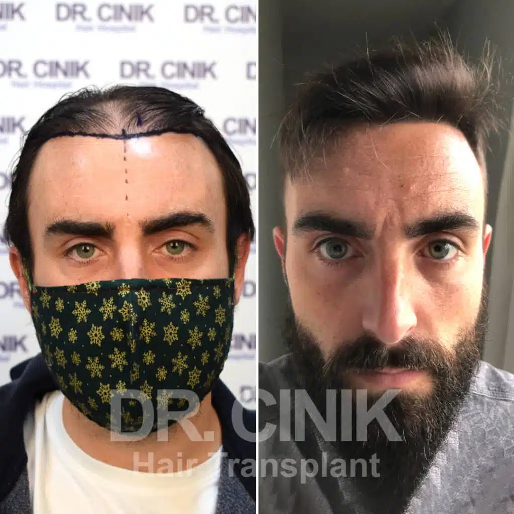 Before and after comparison of a FUE hair transplant with 4232 grafts, showing results 12 months post-procedure. Initial Norwood V pattern showcasing significant transformation.