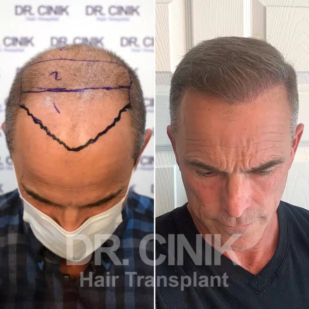 Before and after comparison of a FUE Saphir hair transplant with 4800 grafts, showing results 12 months post-procedure. Initial Norwood VI pattern showcasing significant transformation.