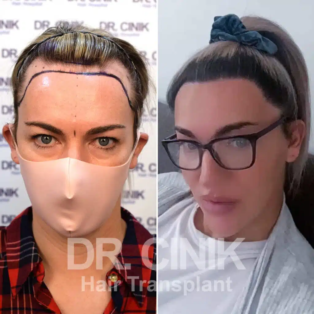 Before and after comparison of a women's hair transplant with 3250 grafts, showing results 11 months post-procedure. Initial Ludwig III pattern showcasing transformation.