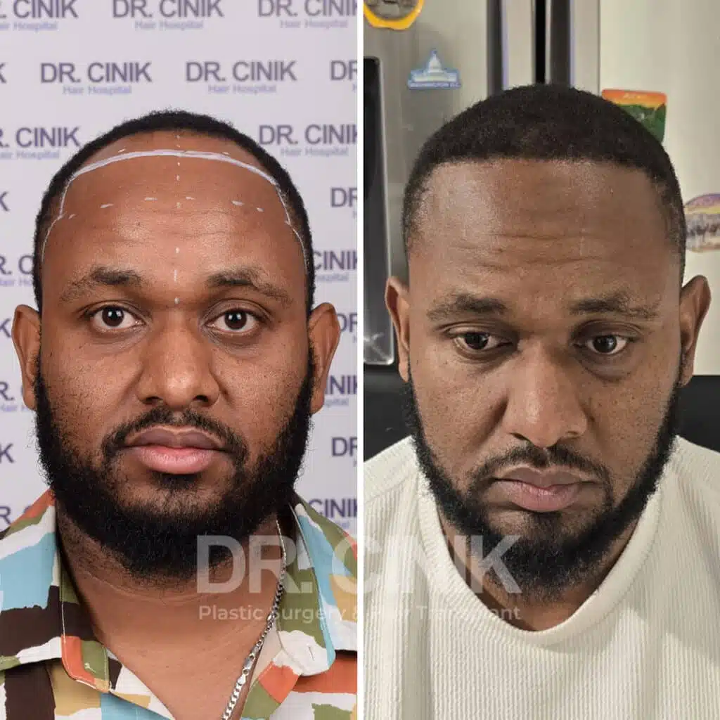 Before and after comparison of an Afro hair transplant with 3550 grafts, showing results 12 months post-procedure. Initial Norwood IV pattern showcasing transformation.