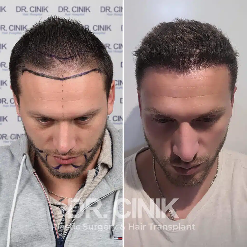 Before and after comparison of a beard hair transplant with 2300 grafts, showing results 12 months post-procedure. Initial Norwood V pattern showcasing transformation.