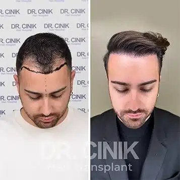 Before and after comparison of a DHI hair transplant with 3200 grafts, showing results 12 months post-procedure. Initial Norwood IV pattern showcasing transformation.