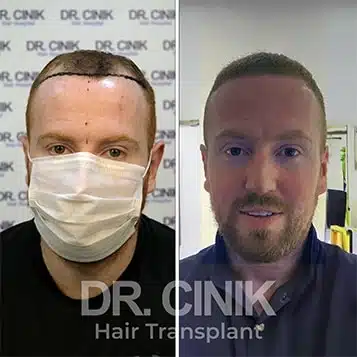 Before and after comparison of a FUE hair transplant with 4200 grafts, showing results 12 months post-procedure. Initial Norwood V pattern showcasing significant transformation.