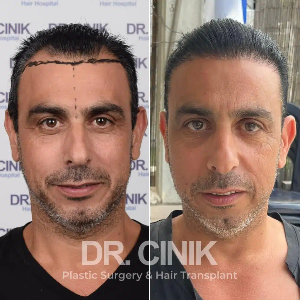 Before and after comparison of a FUE Saphir hair transplant with 3700 grafts, showing results 12 months post-procedure. Initial Norwood V pattern showcasing significant transformation.