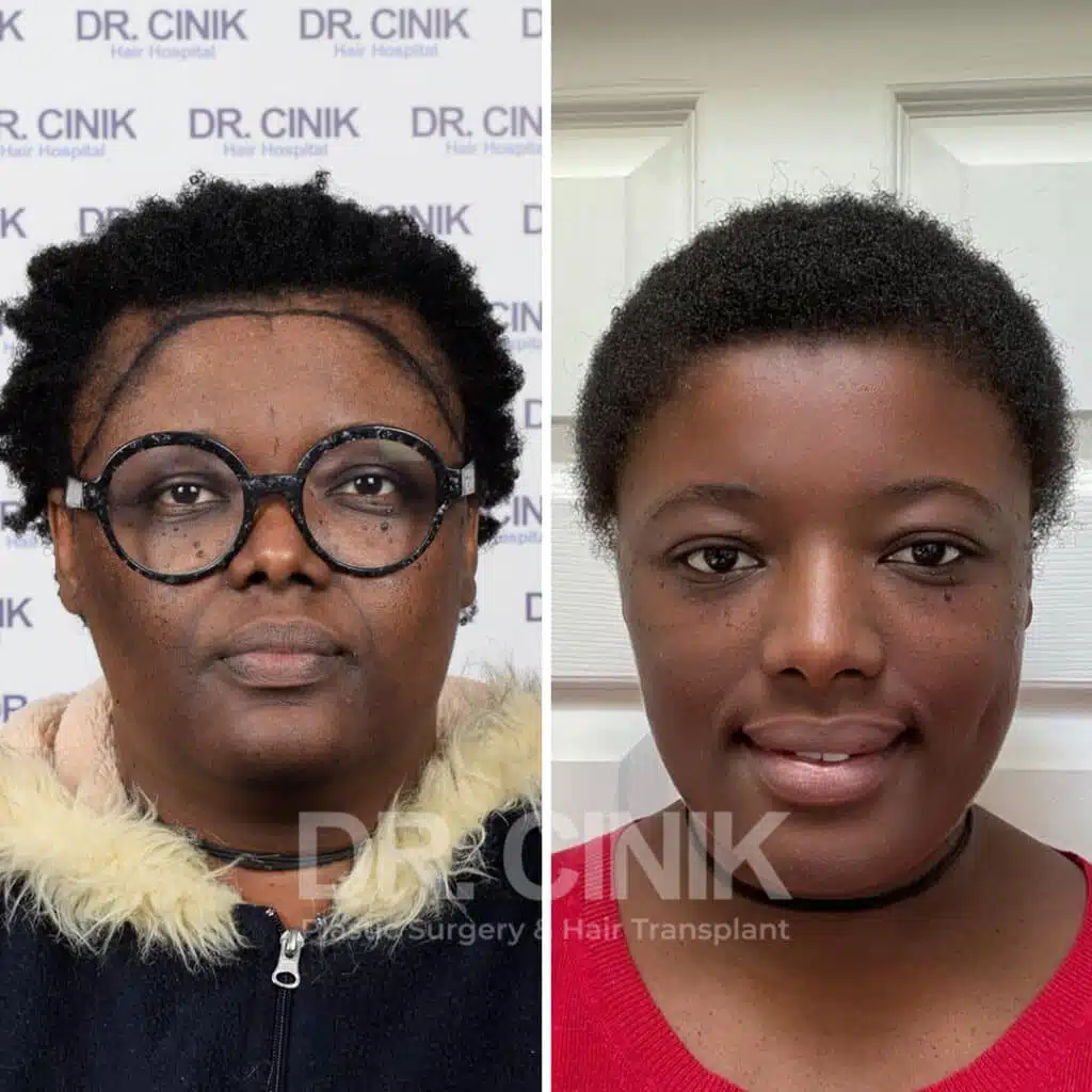 Before and after comparison of a women's hair transplant with 3200 grafts, showing results 11 months post-procedure. Initial Norwood III pattern showcasing transformation.