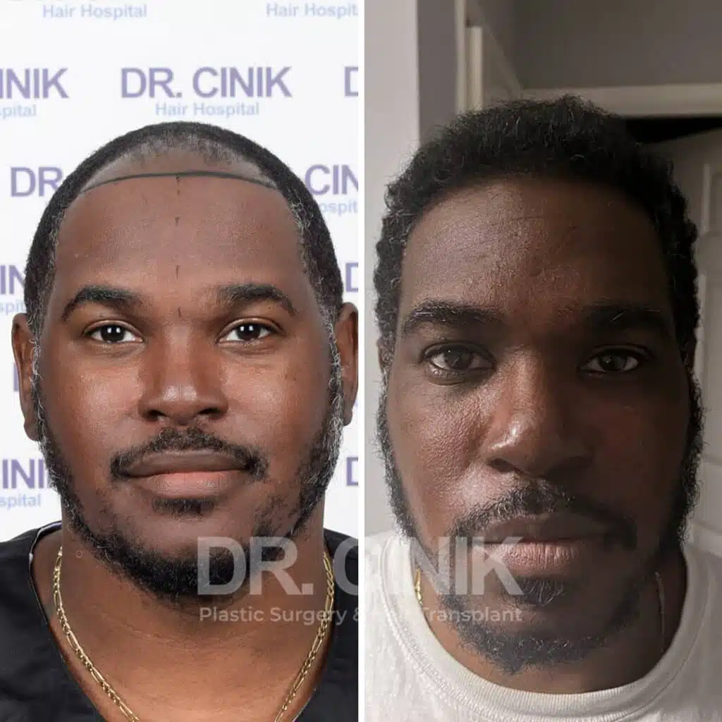 Before and after comparison of an Afro hair transplant with 3000 grafts, showing results 10 months post-procedure. Initial Norwood V pattern showcasing transformation.