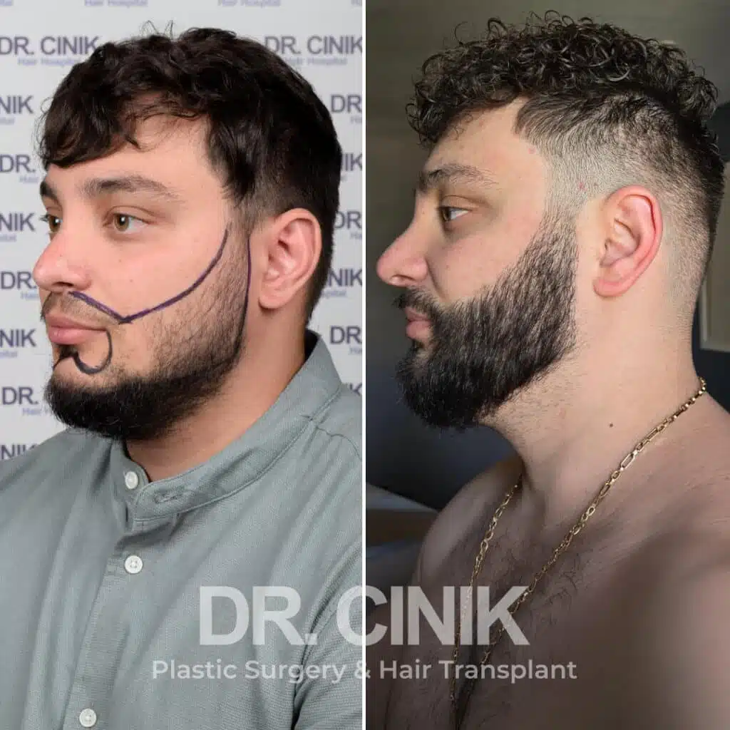 Before and after comparison of a beard hair transplant with 3500 grafts, showing results 12 months post-procedure. Initial Norwood V pattern showcasing transformation.