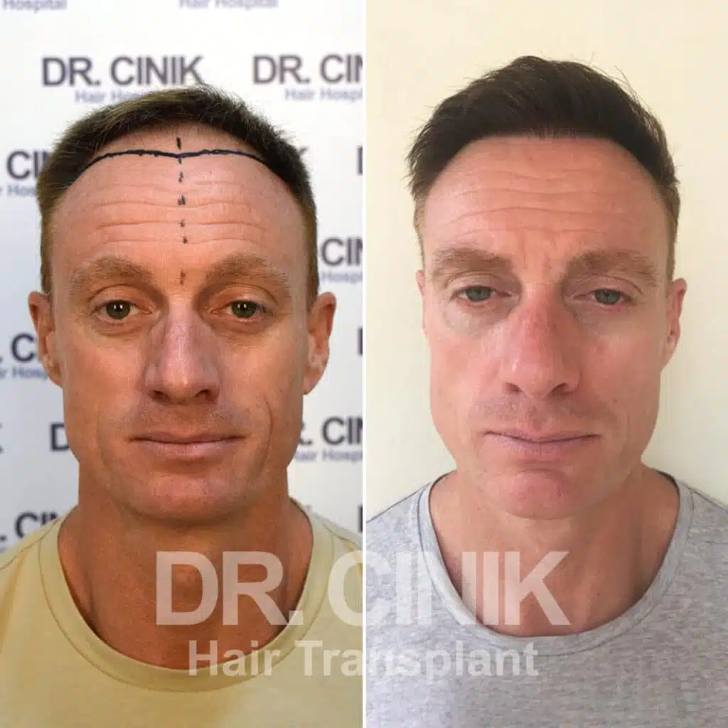 Before and after comparison of a DHI hair transplant with 2750 grafts, showing results 11 months post-procedure. Initial Norwood IV pattern showcasing transformation.
