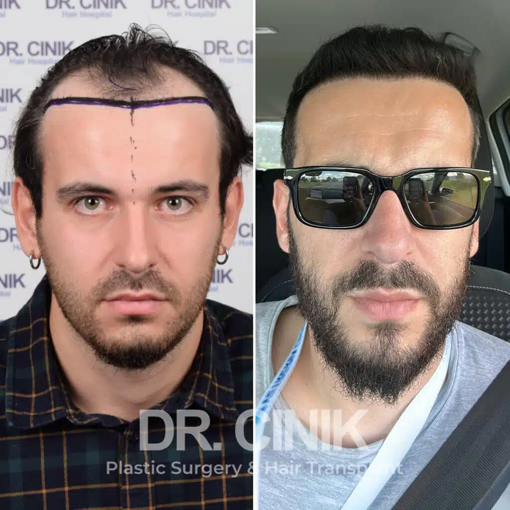 Before and after comparison of a FUE Saphir hair transplant with 3600 grafts, showing results 10 months post-procedure. Initial Norwood IV pattern showcasing transformation.