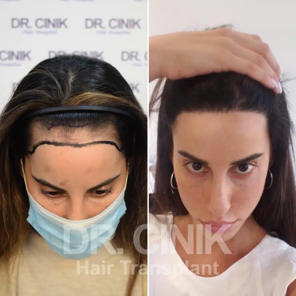 Before and after comparison of a women's hair transplant with 2700 grafts, showing results 12 months post-procedure. Initial Norwood III pattern showcasing transformation.