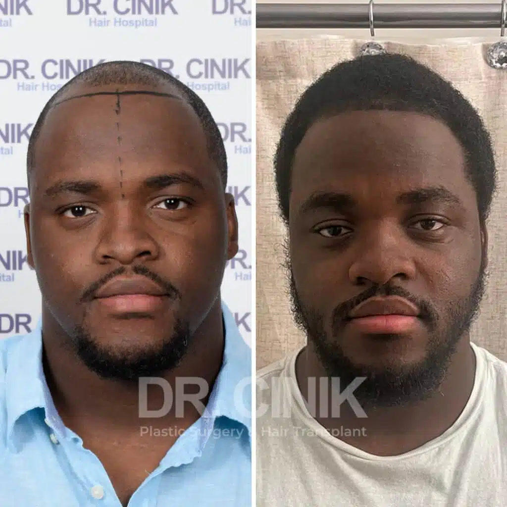 Before and after comparison of an Afro hair transplant with 2500 grafts, showing results 9 months post-procedure. Initial Norwood IV pattern showcasing transformation.