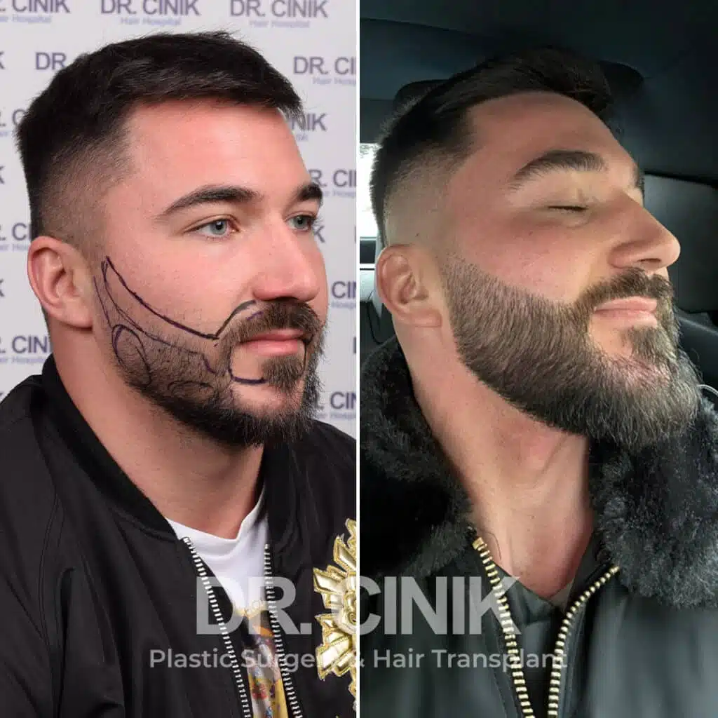 Before and after comparison of a beard hair transplant with 2400 grafts, showing results 12 months post-procedure. Initial Norwood I pattern showcasing transformation.