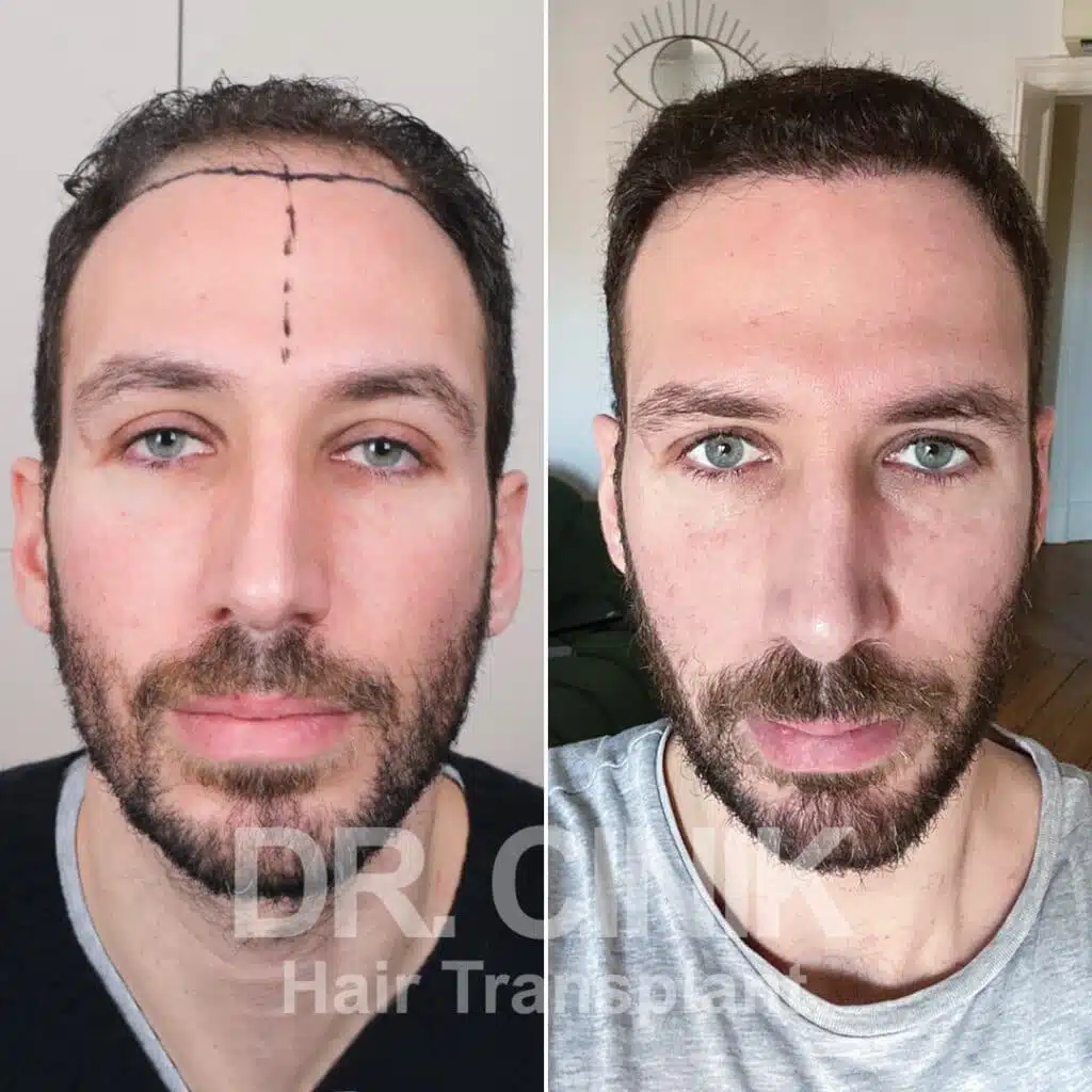 Before and after comparison of a DHI hair transplant with 4200 grafts, showing results 10 months post-procedure. Initial Norwood V pattern showcasing significant transformation.