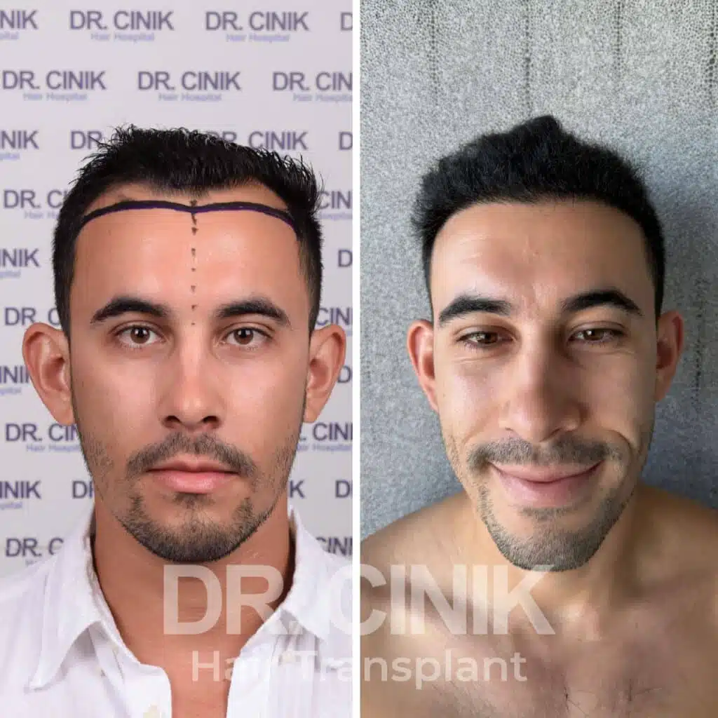 Aprs une greffe de cheveux : les consignes  suivre | DR. Cinik