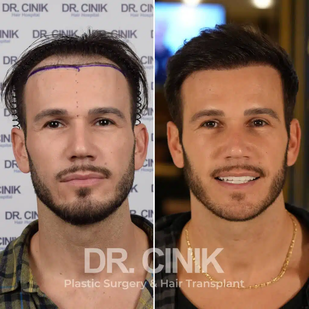 Before and after comparison of a FUE Saphir hair transplant with 3750 grafts, showing results 12 months post-procedure. Initial Norwood IV pattern showcasing transformation.