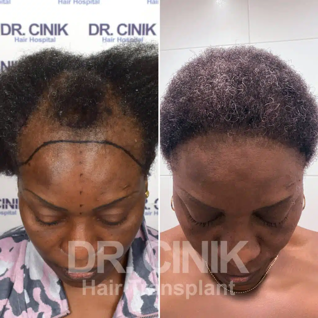 Before and after comparison of a women's hair transplant with 4115 grafts, showing results 8 months post-procedure. Initial Norwood IV pattern showcasing transformation.