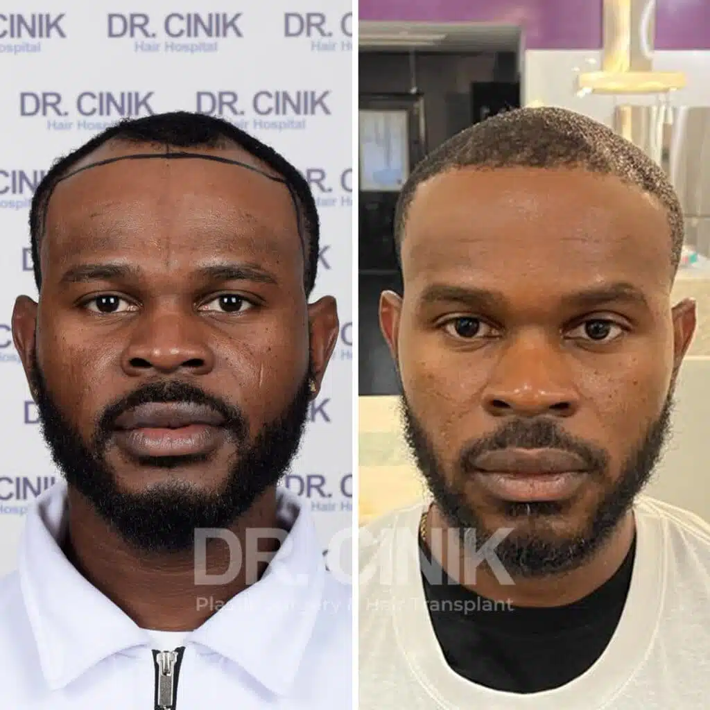 Before and after comparison of an Afro hair transplant with 2900 grafts, showing results 9 months post-procedure. Initial Norwood III pattern showcasing transformation.