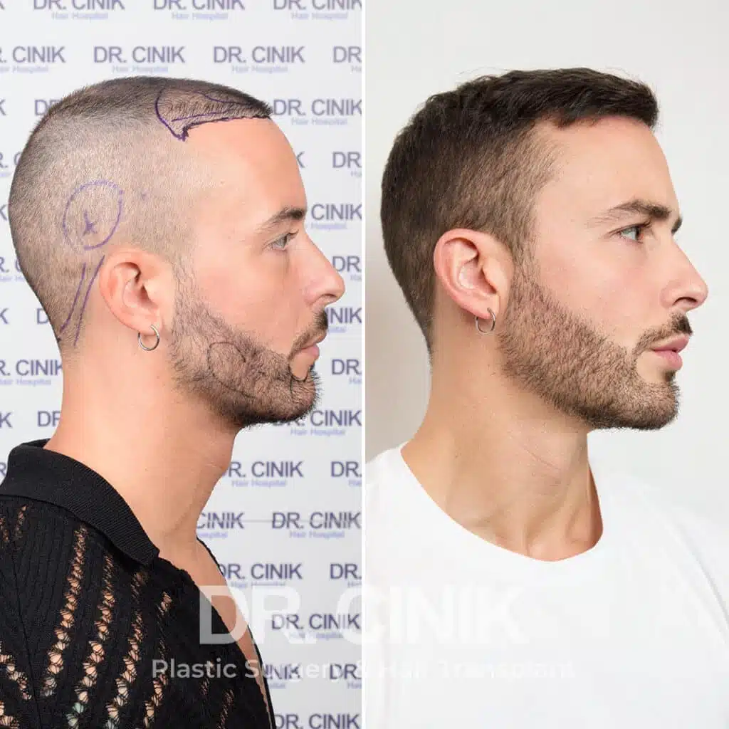 Before and after comparison of a beard hair transplant with 3900 grafts, showing results 12 months post-procedure. Initial Norwood I pattern showcasing transformation.