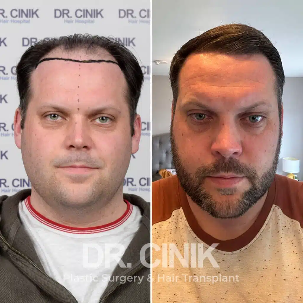Before and after comparison of a DHI hair transplant with 4600 grafts, showing results 9 months post-procedure. Initial Norwood VI pattern showcasing significant transformation.