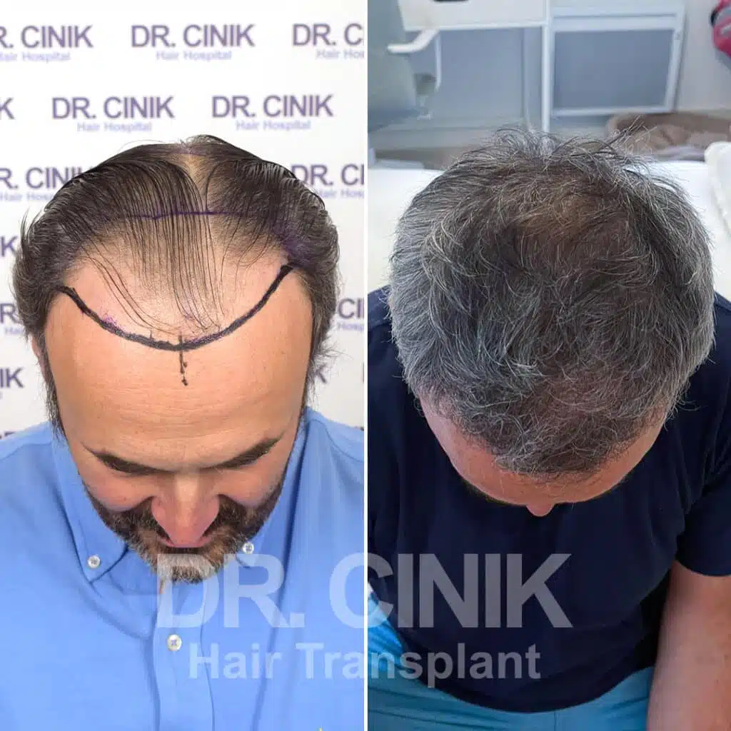 Before and after comparison of a FUE hair transplant with 3350 grafts, showing results 12 months post-procedure. Initial Norwood V pattern showcasing significant transformation.