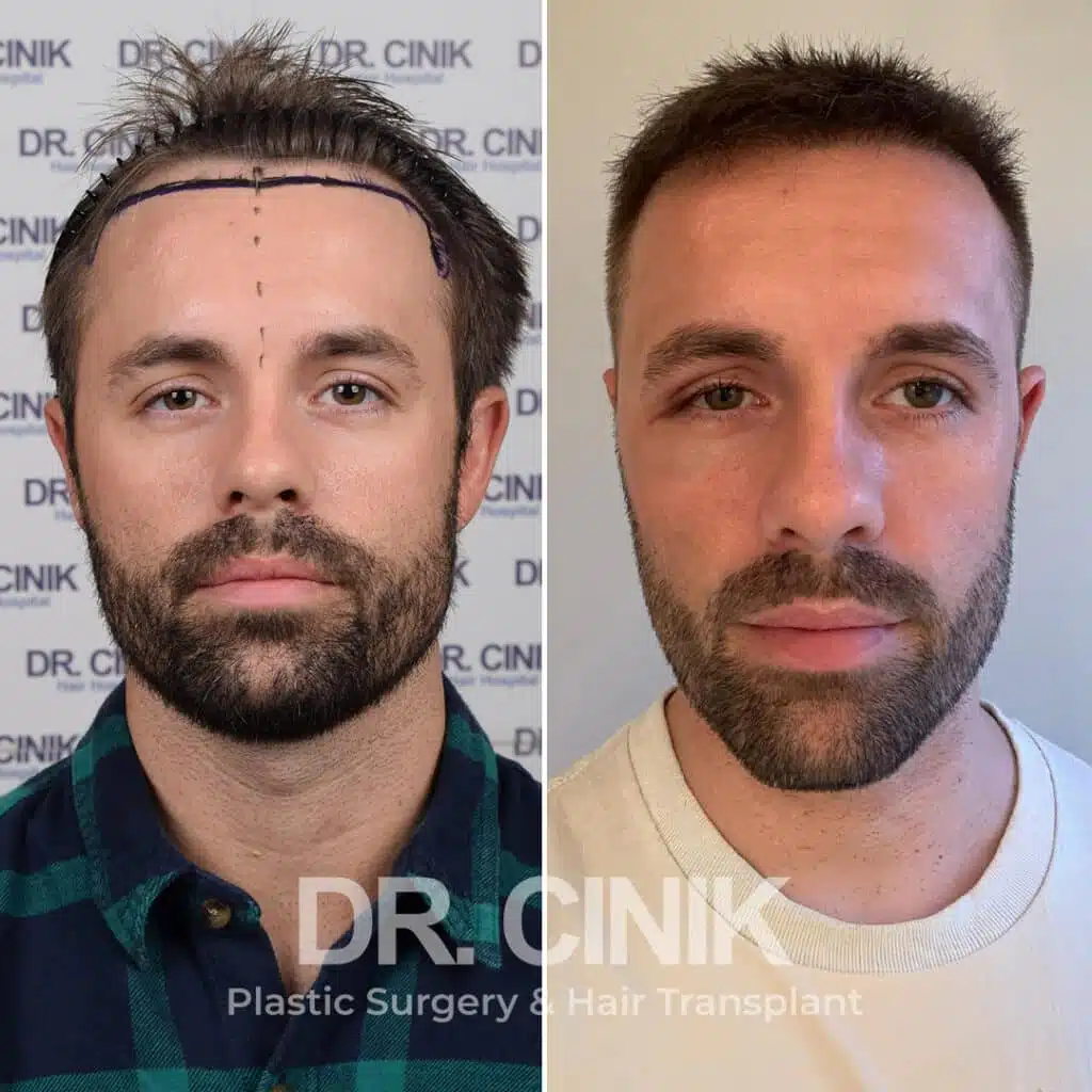 Before and after comparison of a FUE Saphir hair transplant with 2800 grafts, showing results 12 months post-procedure. Initial Norwood III pattern showcasing transformation.