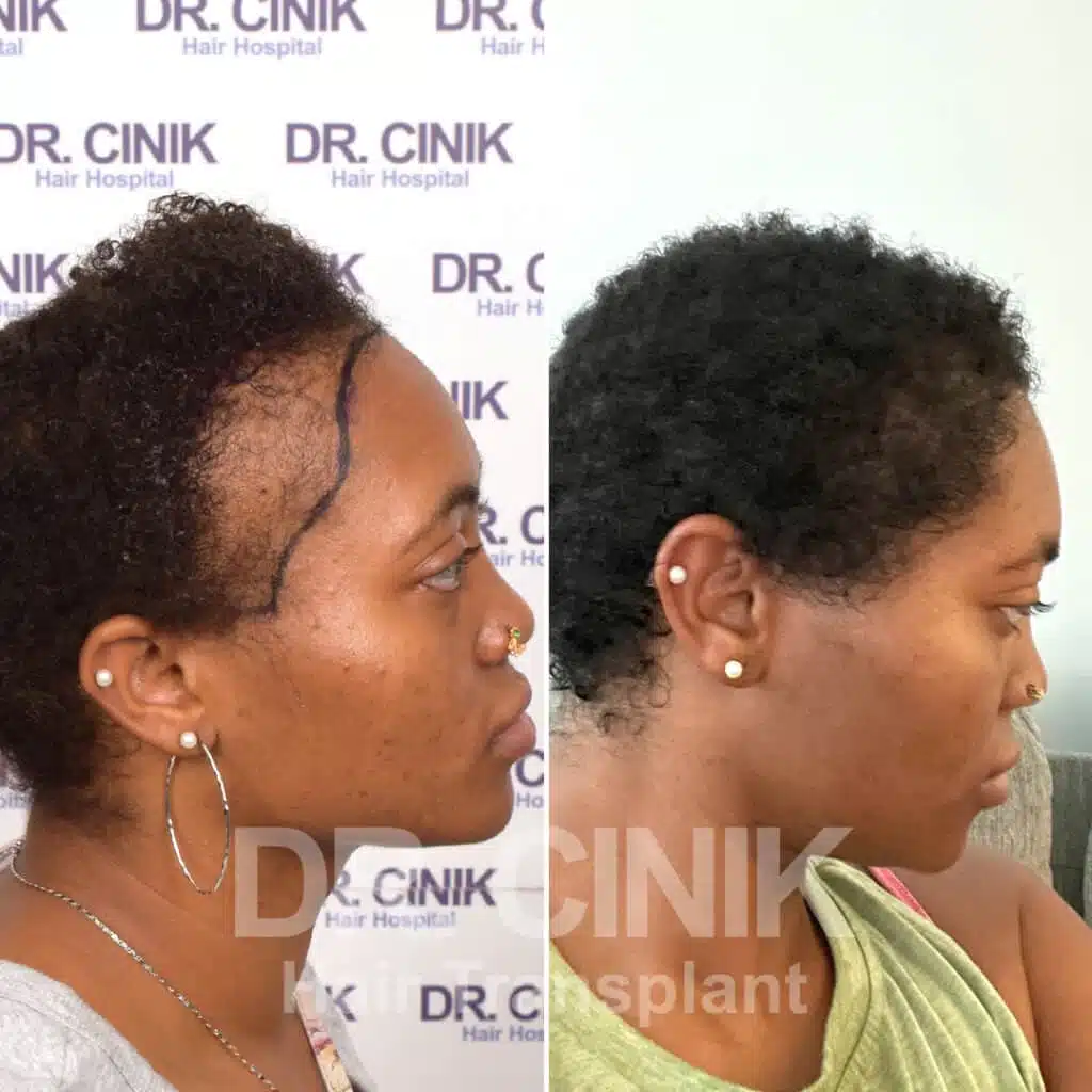 Before and after comparison of a women's hair transplant with 2900 grafts, showing results 9 months post-procedure. Initial Norwood IV pattern showcasing transformation.