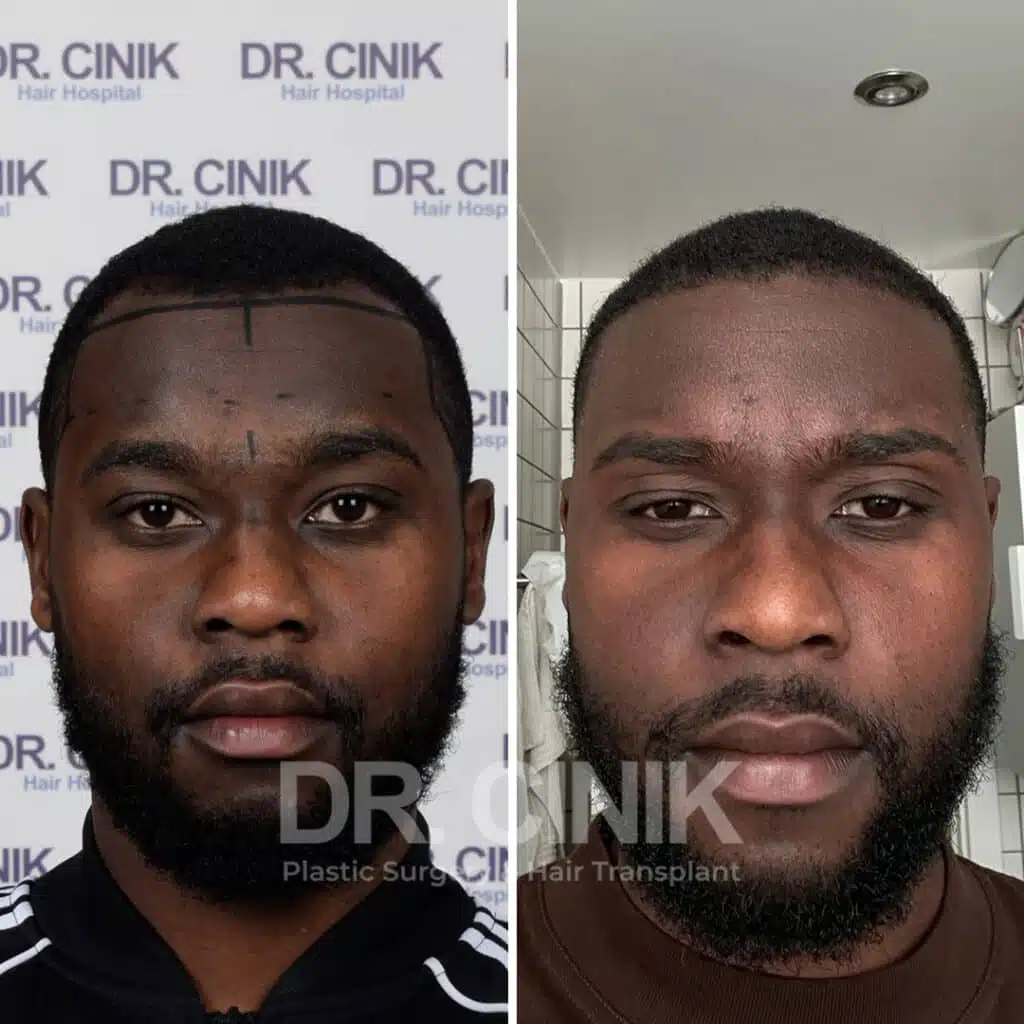 Before and after comparison of an Afro hair transplant with 2400 grafts, showing results 9 months post-procedure. Initial Norwood III pattern showcasing transformation.