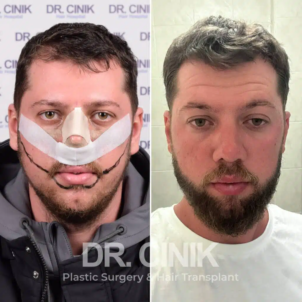 Before and after comparison of a beard hair transplant with 3000 grafts, showing results 12 months post-procedure. Initial Norwood I pattern showcasing transformation.