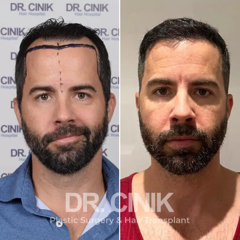 Before and after comparison of a DHI hair transplant with 4300 grafts, showing results 12 months post-procedure. Initial Norwood V pattern showcasing significant transformation.