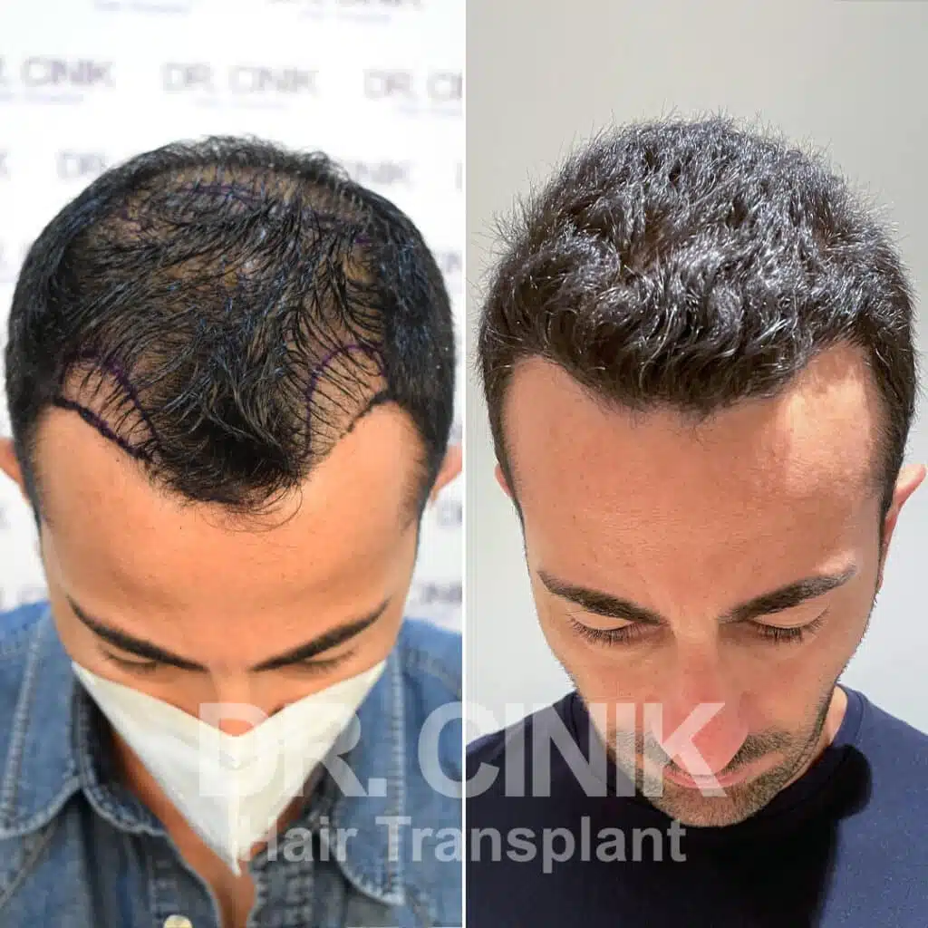 Before and after comparison of a FUE hair transplant with 3500 grafts, showing results 9 months post-procedure. Initial Norwood V pattern showcasing significant hair restoration.