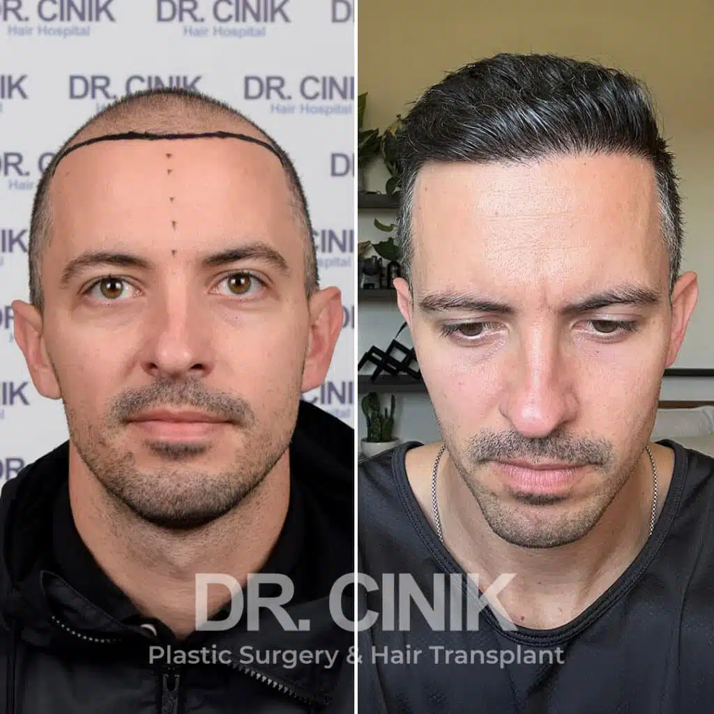 Before and after comparison of a FUE Saphir hair transplant with 3300 grafts, showing results 12 months post-procedure. Initial Norwood IV pattern showcasing transformation.