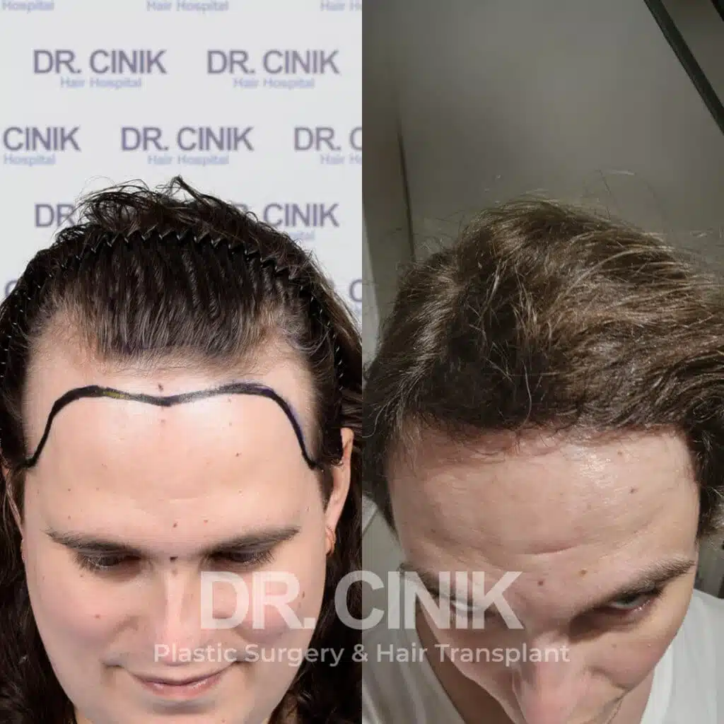 Before and after comparison of a women's hair transplant with 3900 grafts, showing results 9 months post-procedure. Initial Norwood IV pattern showcasing transformation.