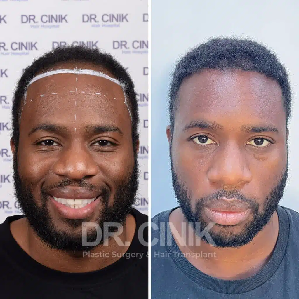 Before and after comparison of an Afro hair transplant with 3325 grafts, showing results 12 months post-procedure. Initial Norwood V pattern showcasing significant transformation.