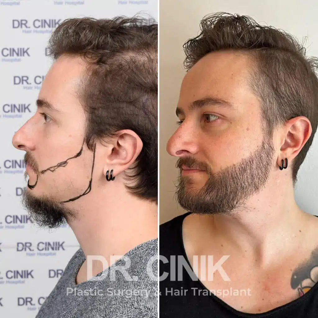 Before and after comparison of a beard hair transplant with 3350 grafts, showing results 12 months post-procedure. Initial beard transplant pattern showcasing transformation.