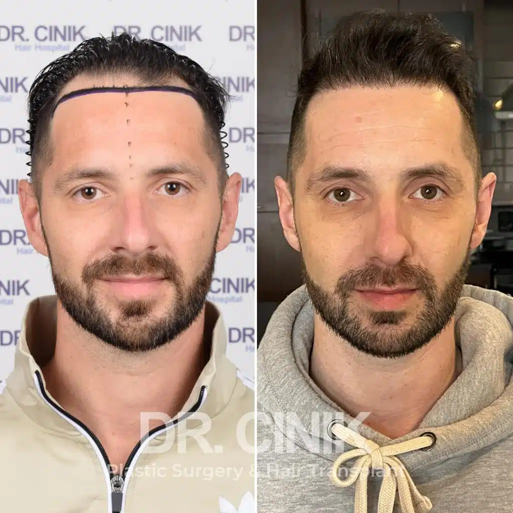 Before and after comparison of a DHI hair transplant with 3100 grafts, showing results 9 months post-procedure. Initial Norwood IV pattern showcasing transformation.