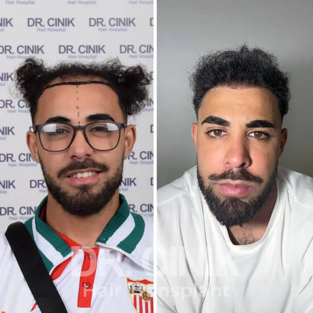 Before and after comparison of a FUE hair transplant with 4350 grafts, showing results 12 months post-procedure. Initial Norwood V pattern showcasing significant transformation.