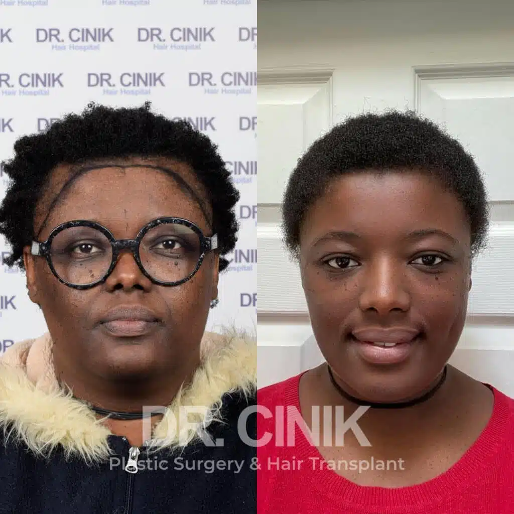 Before and after comparison of a women's hair transplant with 3200 grafts, showing results 12 months post-procedure. Initial Norwood III pattern showcasing transformation.