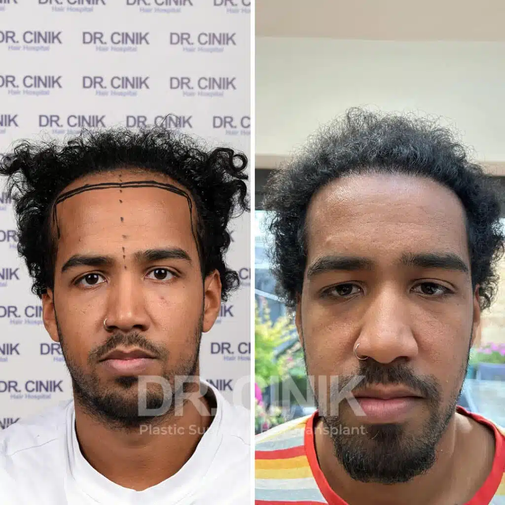 Before and after comparison of an Afro hair transplant with 3750 grafts, showing results 12 months post-procedure. Initial Norwood V pattern showcasing transformation.