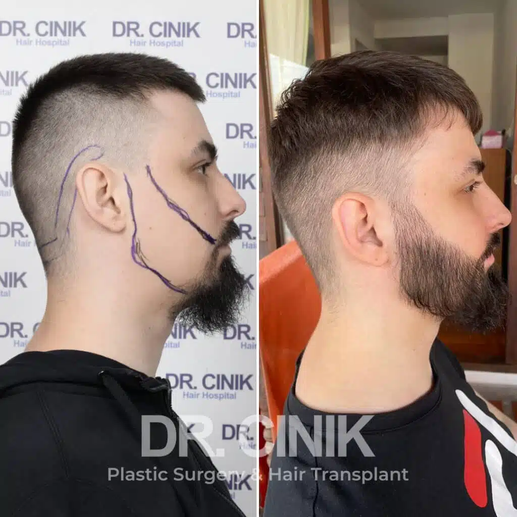 Before and after comparison of a beard hair transplant with 3500 grafts, showing results 9 months post-procedure. Initial beard transplant pattern showcasing transformation.