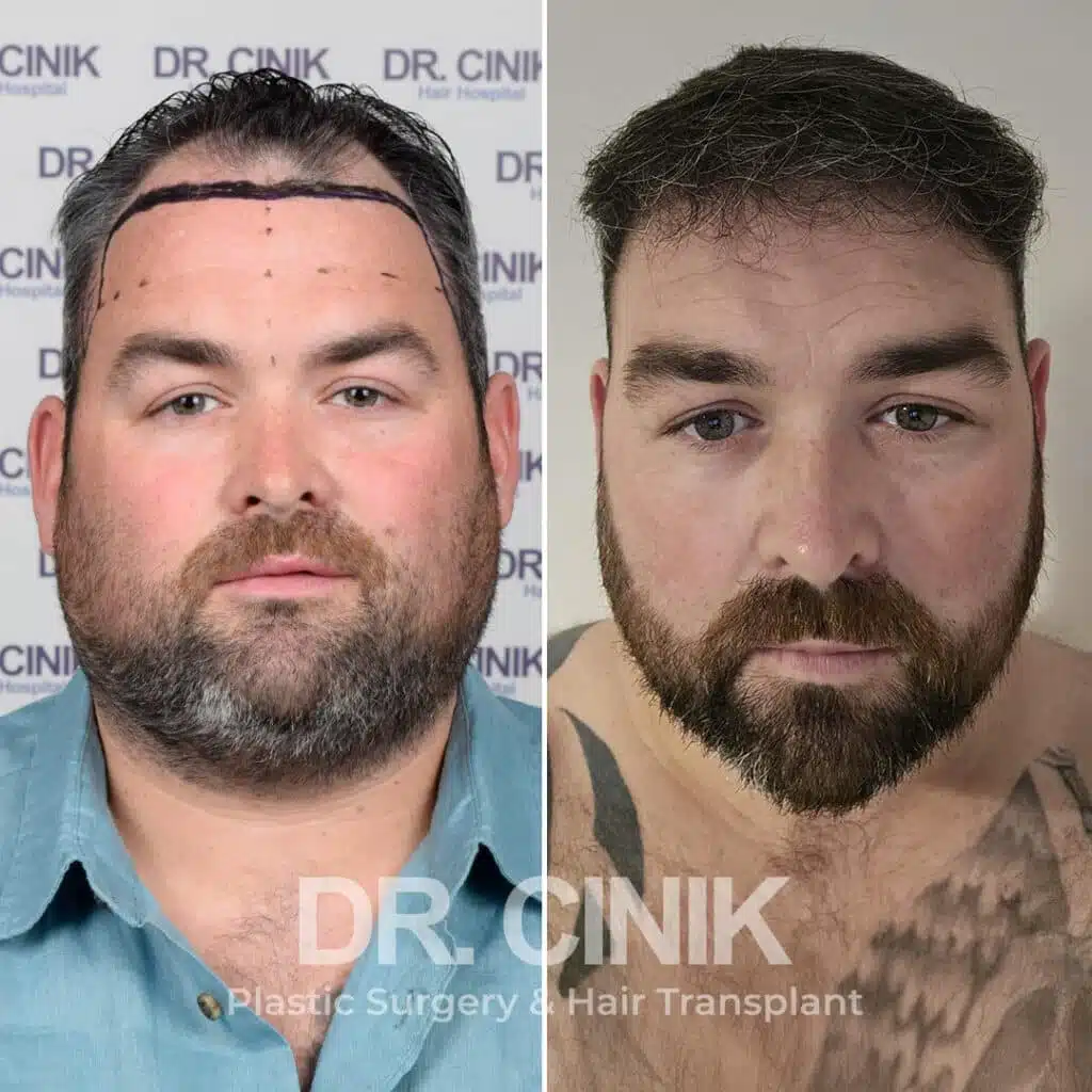 Before and after comparison of a DHI hair transplant with 3600 grafts, showing results 9 months post-procedure. Initial Norwood V pattern showcasing significant transformation.