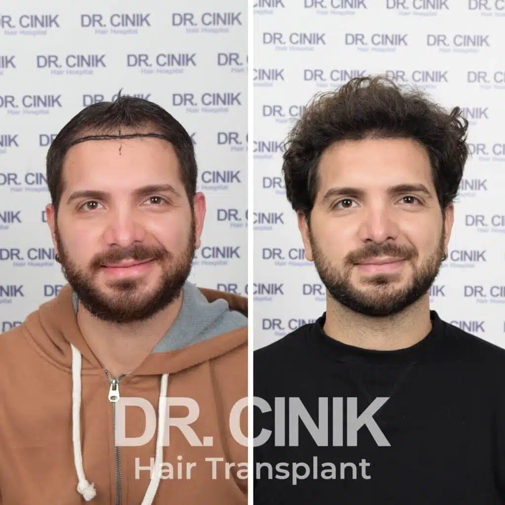 Before and after comparison of a FUE hair transplant with 4150 grafts, showing results 12 months post-procedure. Initial Norwood V pattern showcasing significant transformation.