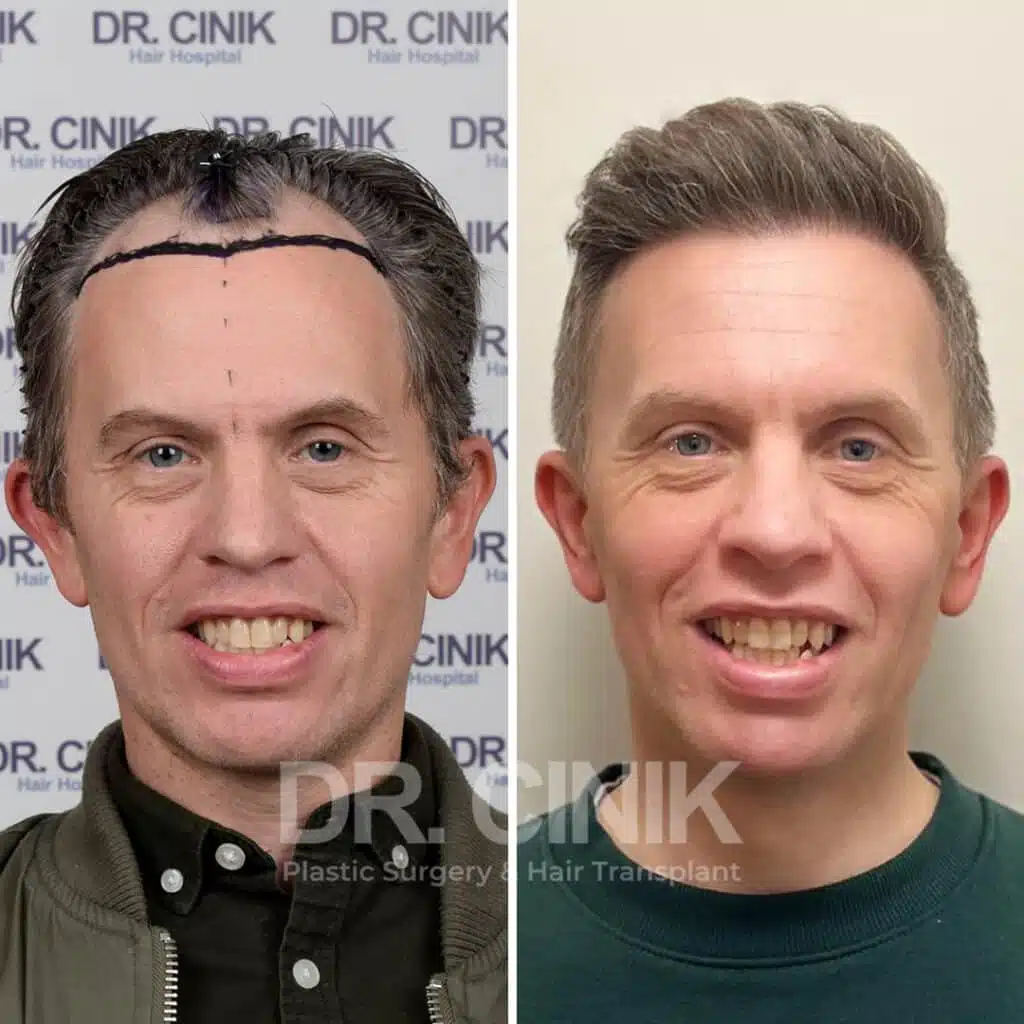 Before and after comparison of a FUE Saphir hair transplant with 2800 grafts, showing results 10 months post-procedure. Initial Norwood IV pattern showcasing transformation.