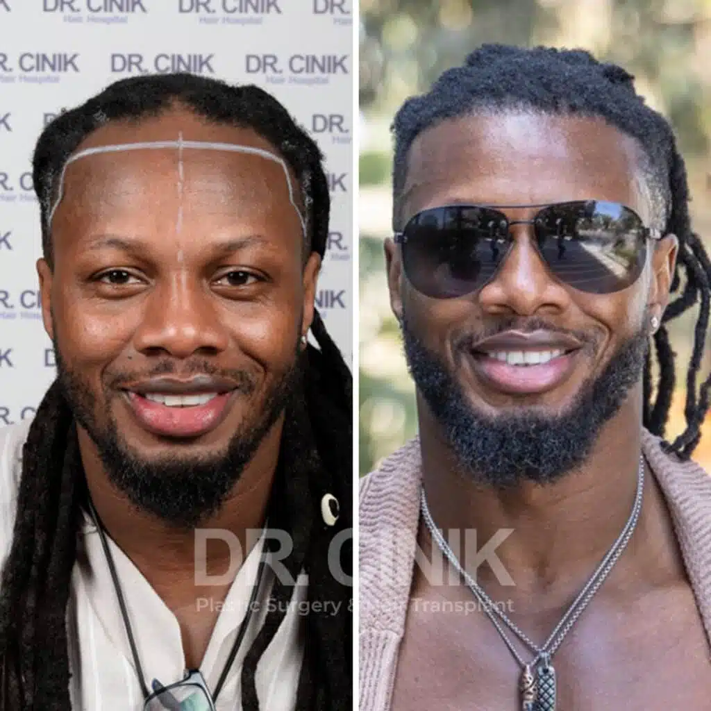 Before and after comparison of an Afro hair transplant with 2900 grafts, showing results 12 months post-procedure. Initial Norwood III pattern showcasing transformation.