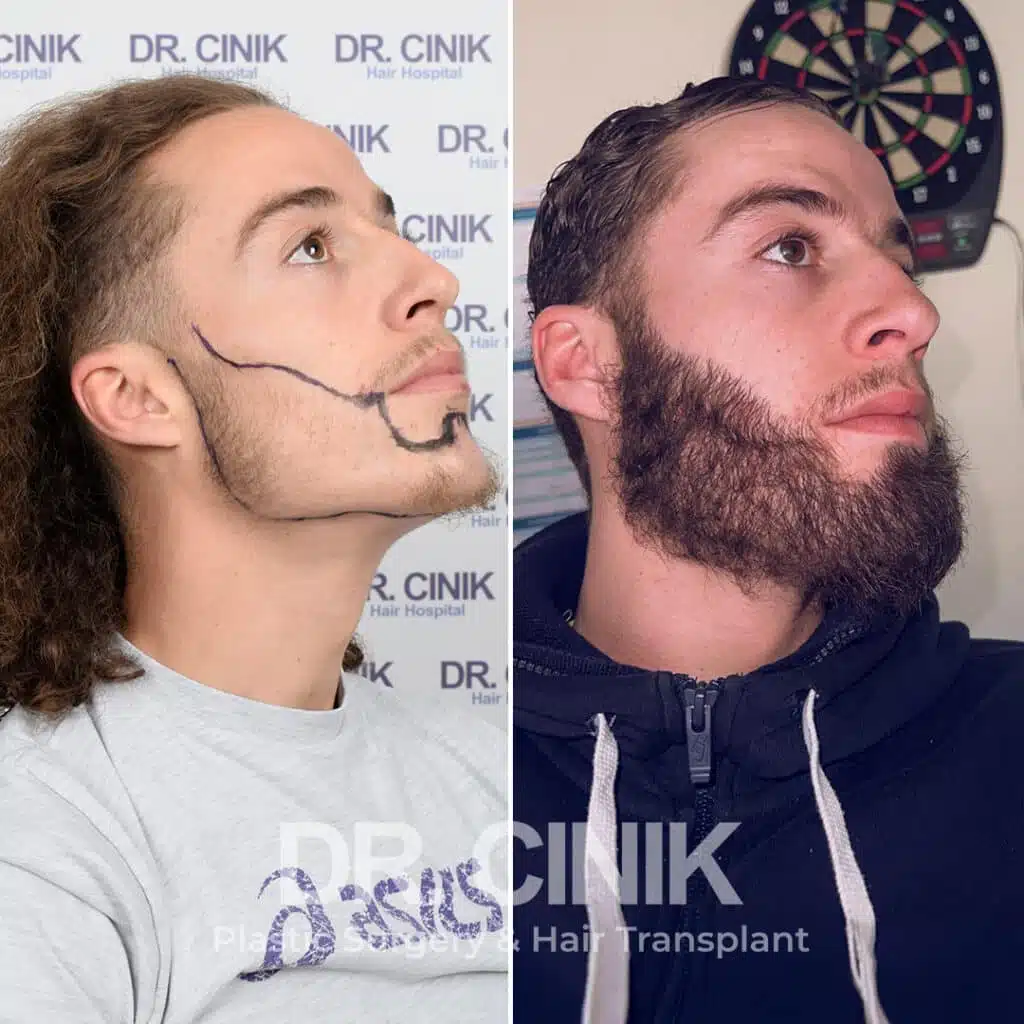 Before and after comparison of a beard hair transplant with 3400 grafts, showing results 10 months post-procedure. Initial beard transplant pattern showcasing transformation.