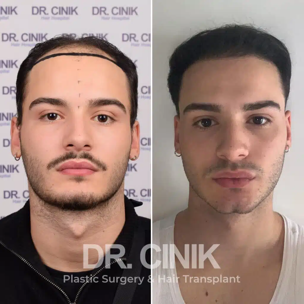 Before and after comparison of a DHI hair transplant with 3000 grafts, showing results 9 months post-procedure. Initial Norwood V pattern showcasing significant transformation.