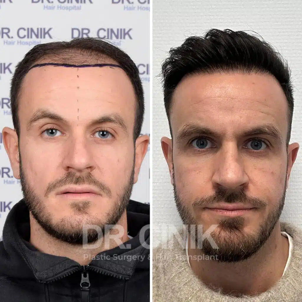 Before and after comparison of a FUE Saphir hair transplant with 4200 grafts, showing results 10 months post-procedure. Initial Norwood V pattern showcasing transformation.